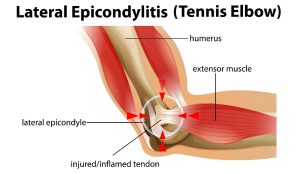 How Did I Get Tennis Elbow?